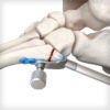 5th Metatarsal Hook Plates - Image 4