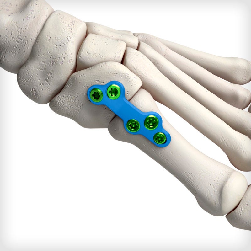 Lapidus Plates Unite Foot and Ankle