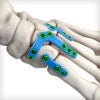 Lisfranc ICJ Arm Plates - Image 2