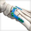 Lisfranc ICJ Arm Plates - Image 3