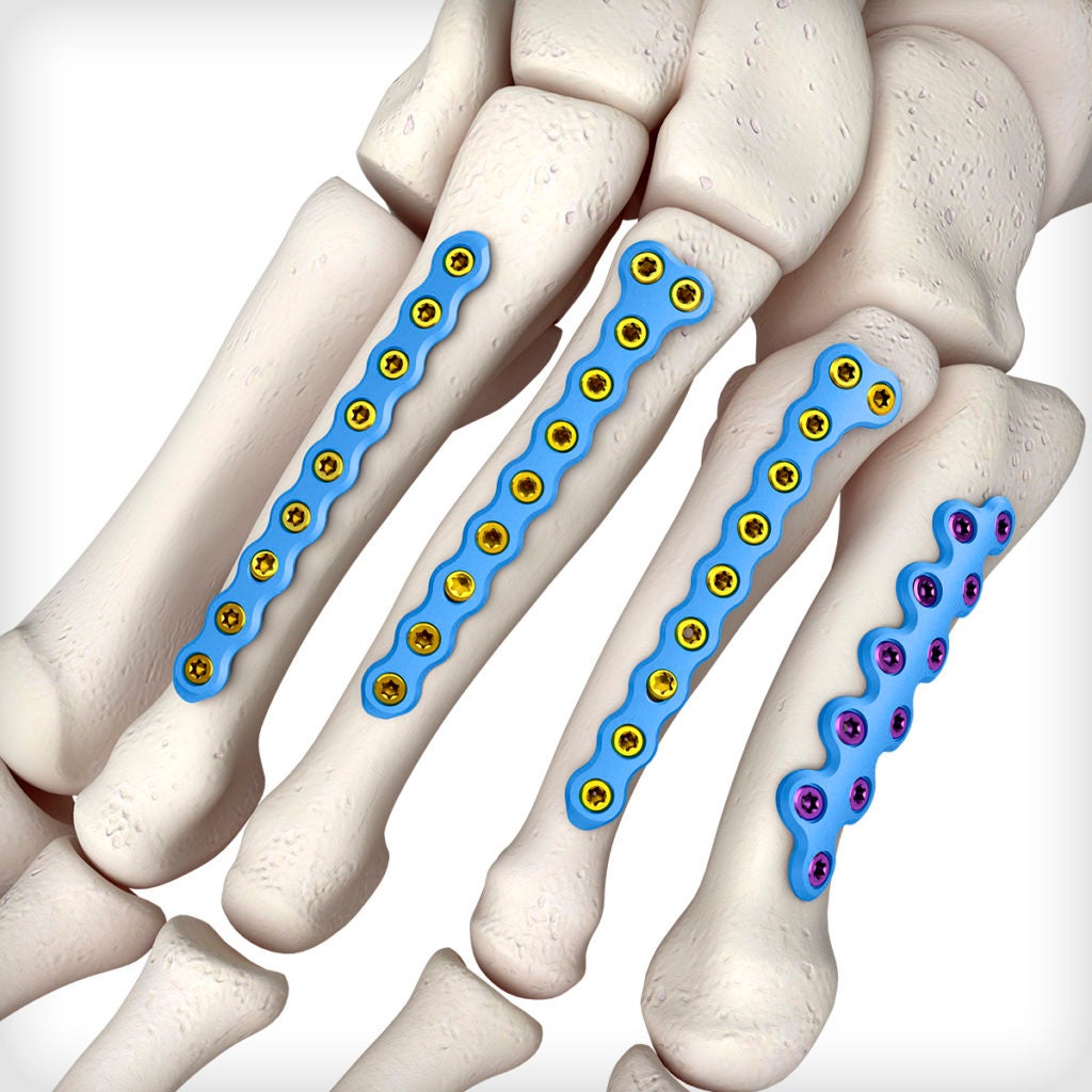 Metatarsal T Plates Unite Foot and Ankle