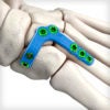 Lisfranc Plates