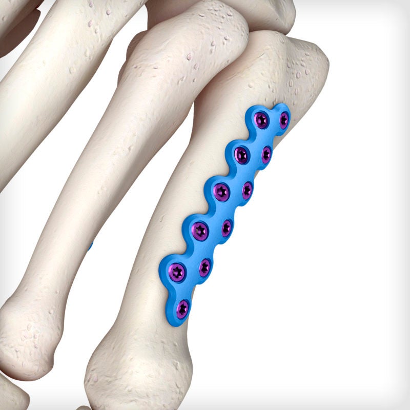Metatarsal Z Plates Unite Foot and Ankle