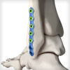 Flex Fibula Plates