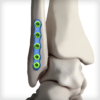 Flex Fibula Plates - Image 2