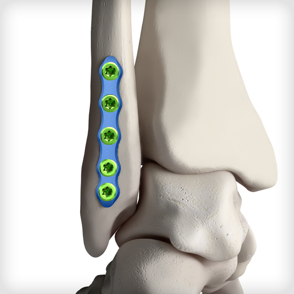 Flex Fibula Plates Unite Foot And Ankle