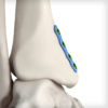 Flex Fibula Plates - Image 3