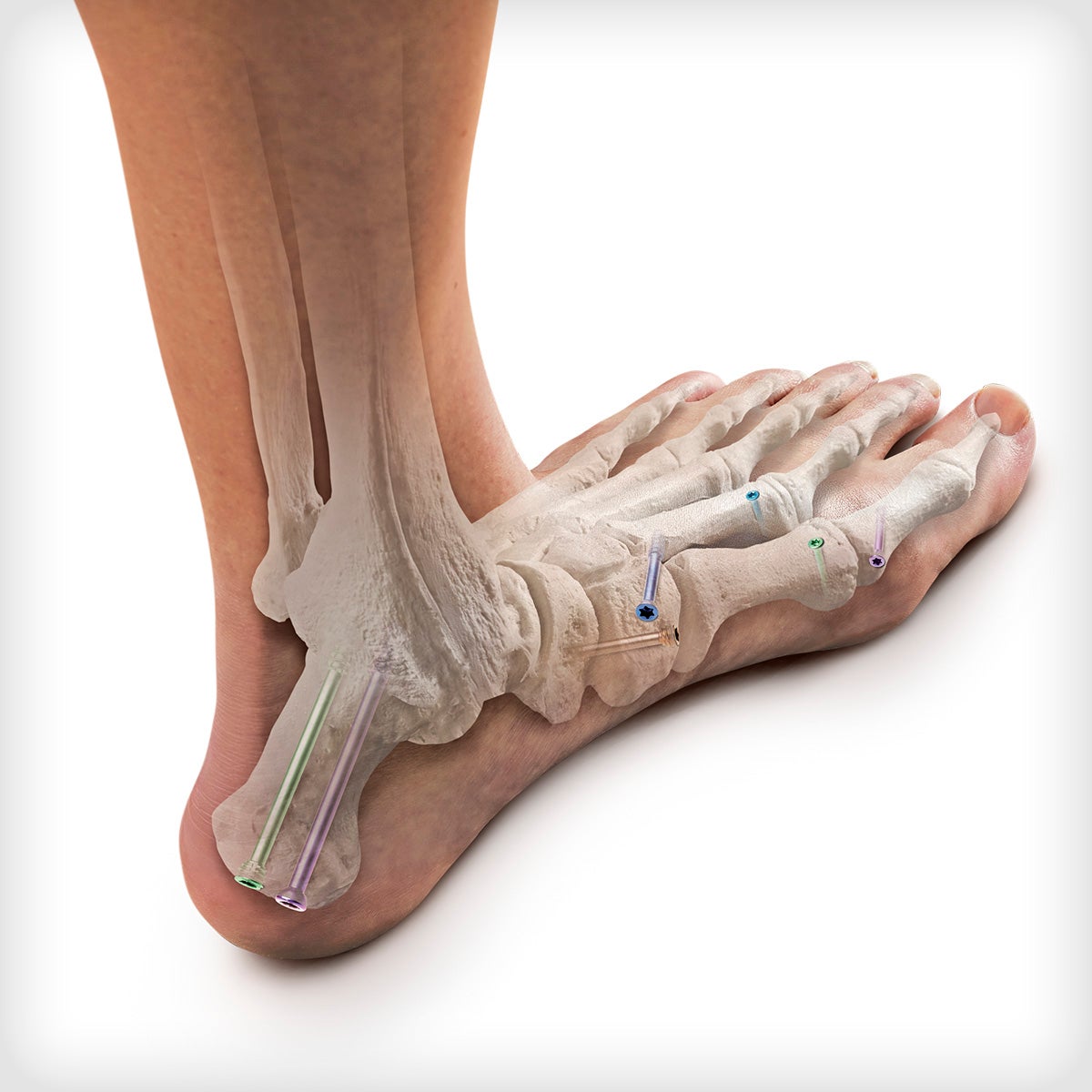 Screw Systems Unite Foot and Ankle