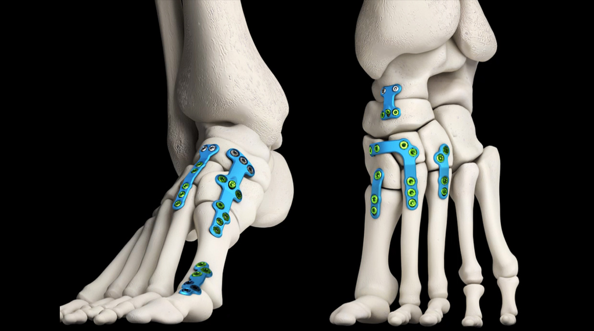 REFLEX® Nitinol Staples - Unite Foot and Ankle