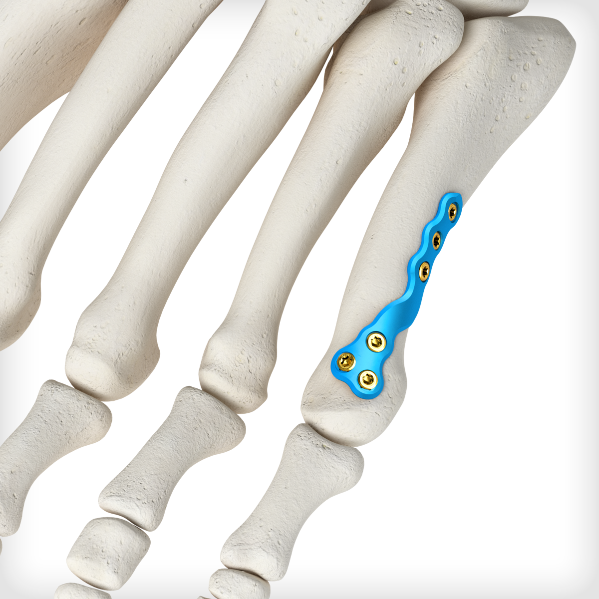 metatarsal fracture