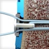 SYNDEX™ with Constrictor® Technology