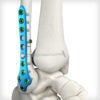 SYNDEX™ with Constrictor® Technology - Image 2