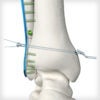 SYNDEX™ with Constrictor® Technology - Image 3