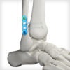 SYNDEX™ with Constrictor® Technology - Image 6