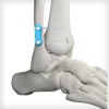 SYNDEX™ with Constrictor® Technology - Image 7