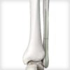 IM Fibula Implant