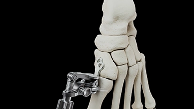 180_Reflex Lapidus Technique_THUMB