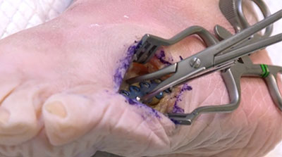 5th-Met-Midshaft-Fracture-Surgical-Technique-1