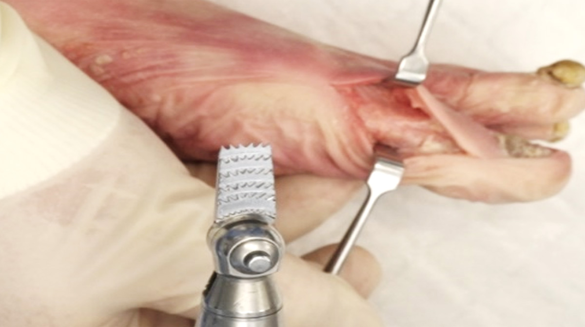Akin-Osteotomy-Reflex-Nitinol-staple
