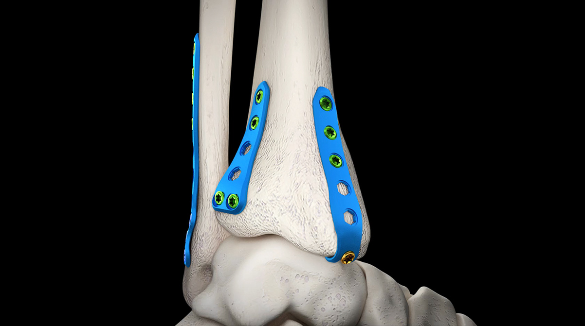 Ankle-2