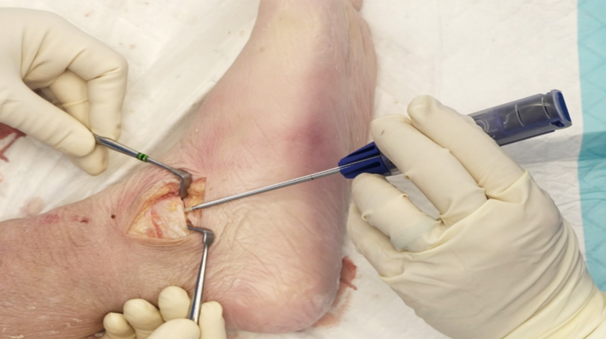 Deltoid-Ligament-Repair-Push