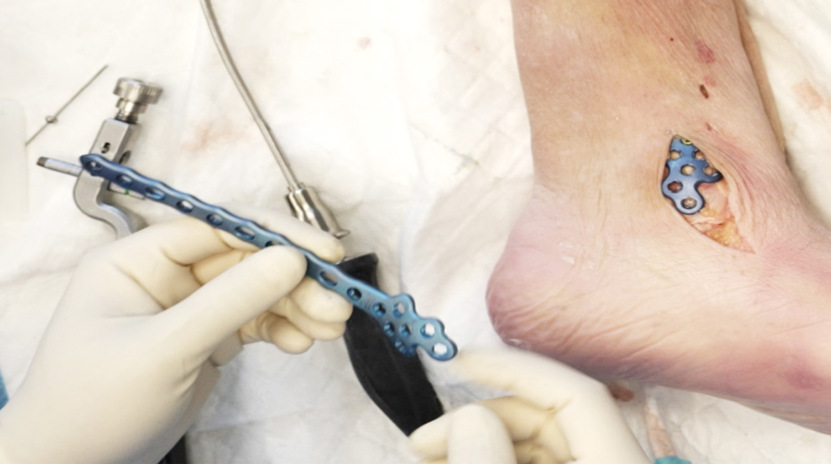 DistalTibia-Fracture_Plating