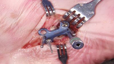 Evans-Osteotomy-Technique