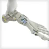 REFLEX® HYBRID Nitinol Implants - Image 5