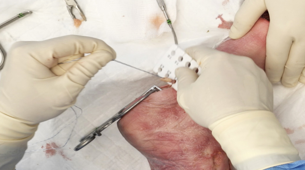 FHL-Tendon-Transfer-with-Tenodesis-Screw