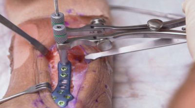 Fibula-Lengthening-Distractor-Demo