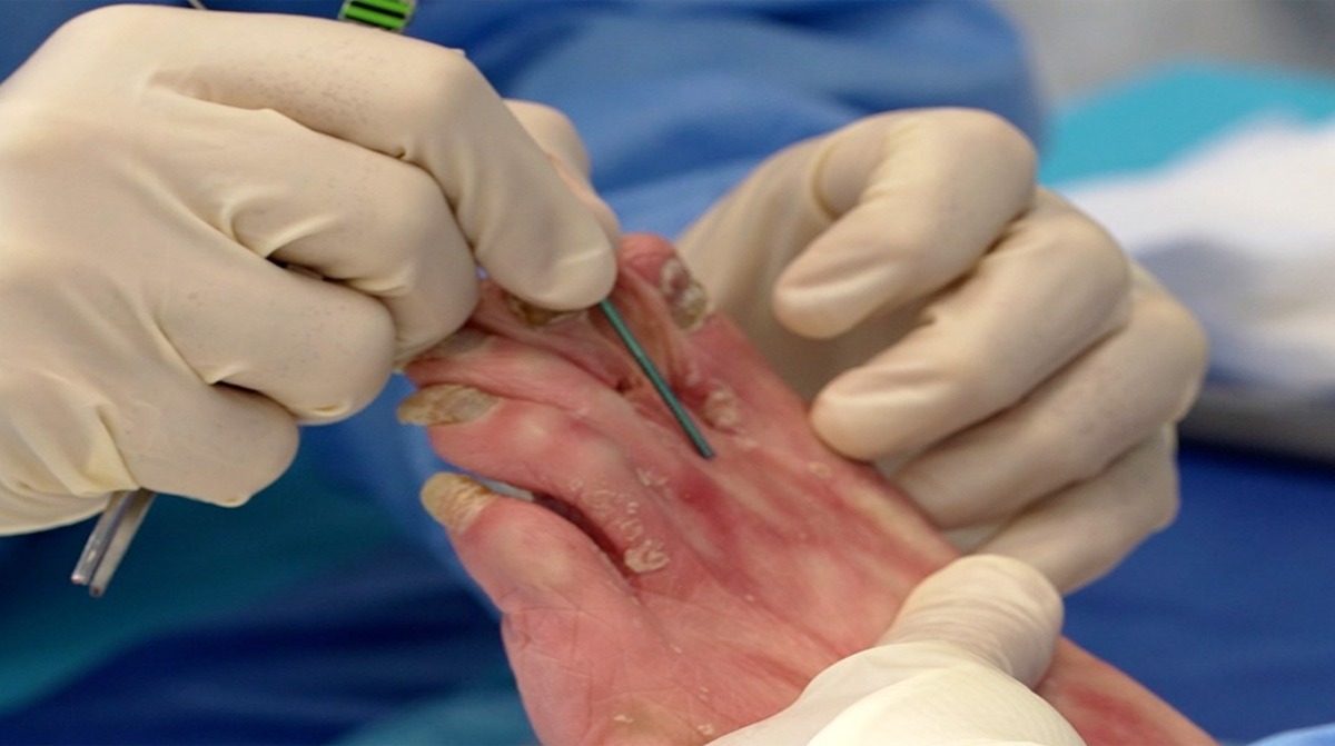 Hammertoe-Repair-with-Digital-Fusion-Implant