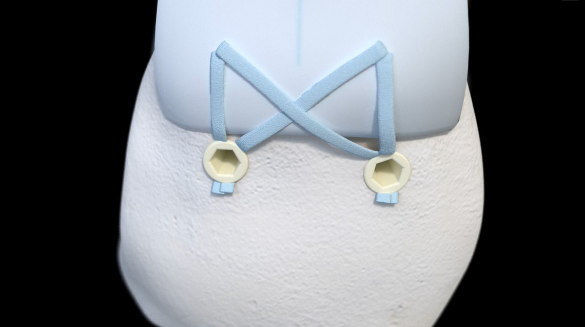 Insertional-Achilles-Repair_Knotless-Anchors_Animation