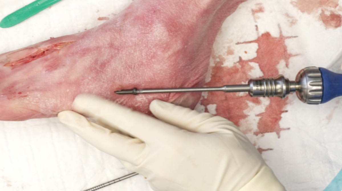 Jones-Fracture-Repair