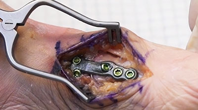 Lapidus-Dual-Mode-Compression-Surgical-Technique-1