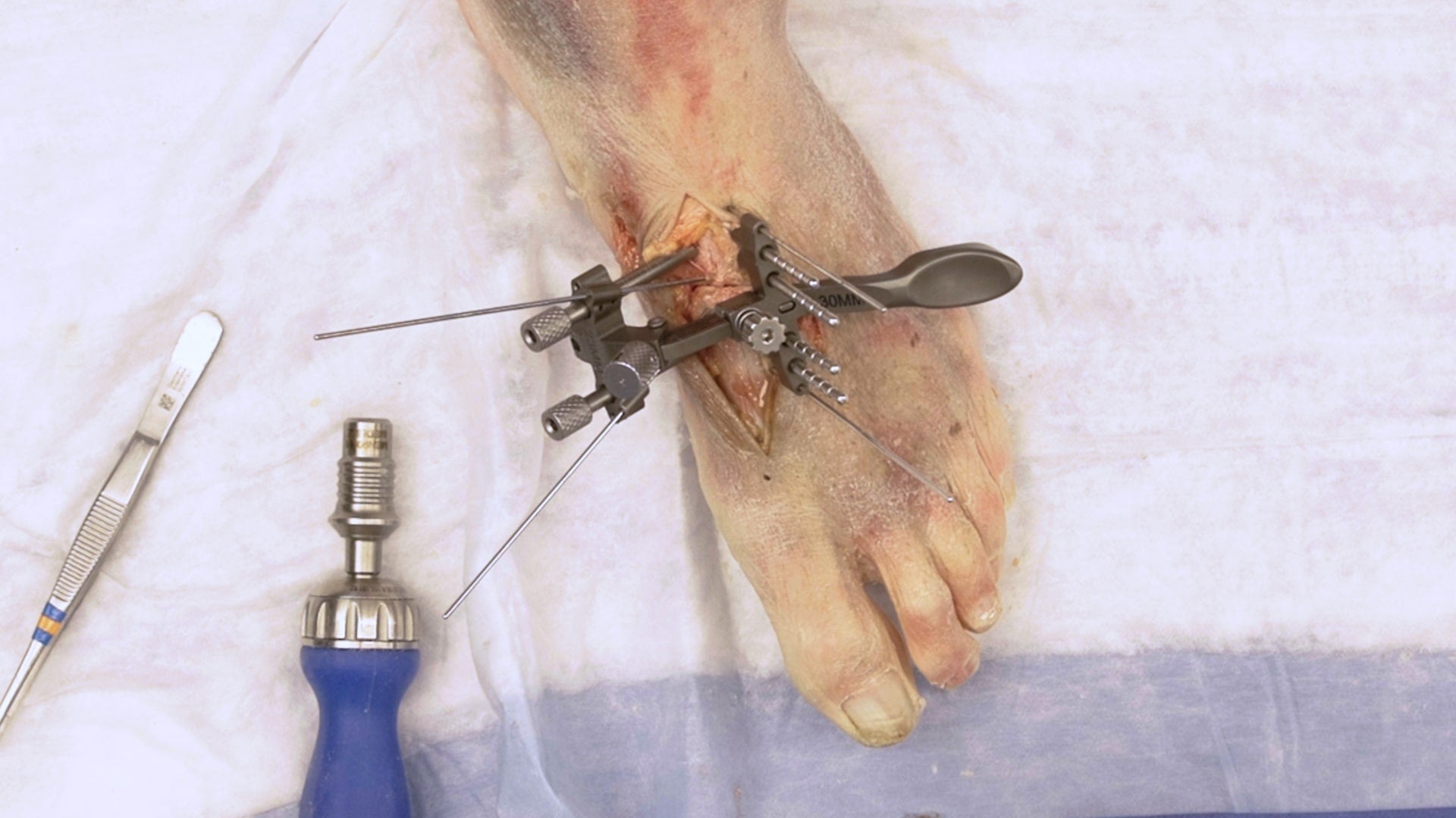 Lapidus-Procedure-Updated-Thumbnail-min
