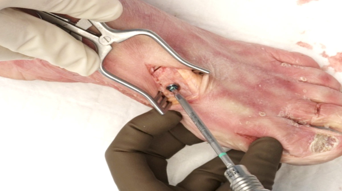 Lapidus-Procedure-with-Reflex-Dynamic-Compression