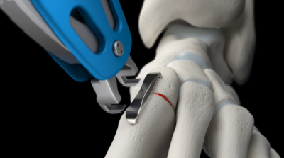 Lapidus-with-REFLEX-Nitinol-Staple