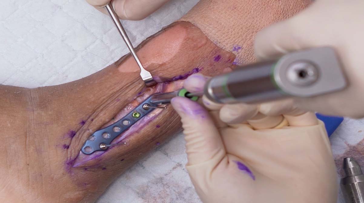 Lateral-Fibula-Plate-Cadaveric-Demo