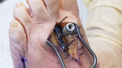 Lesser-Metatarsal-Fracture-Surgical-Technique-1