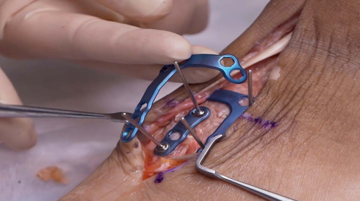 Lisfranc-Plating-Cadaveric-Demo