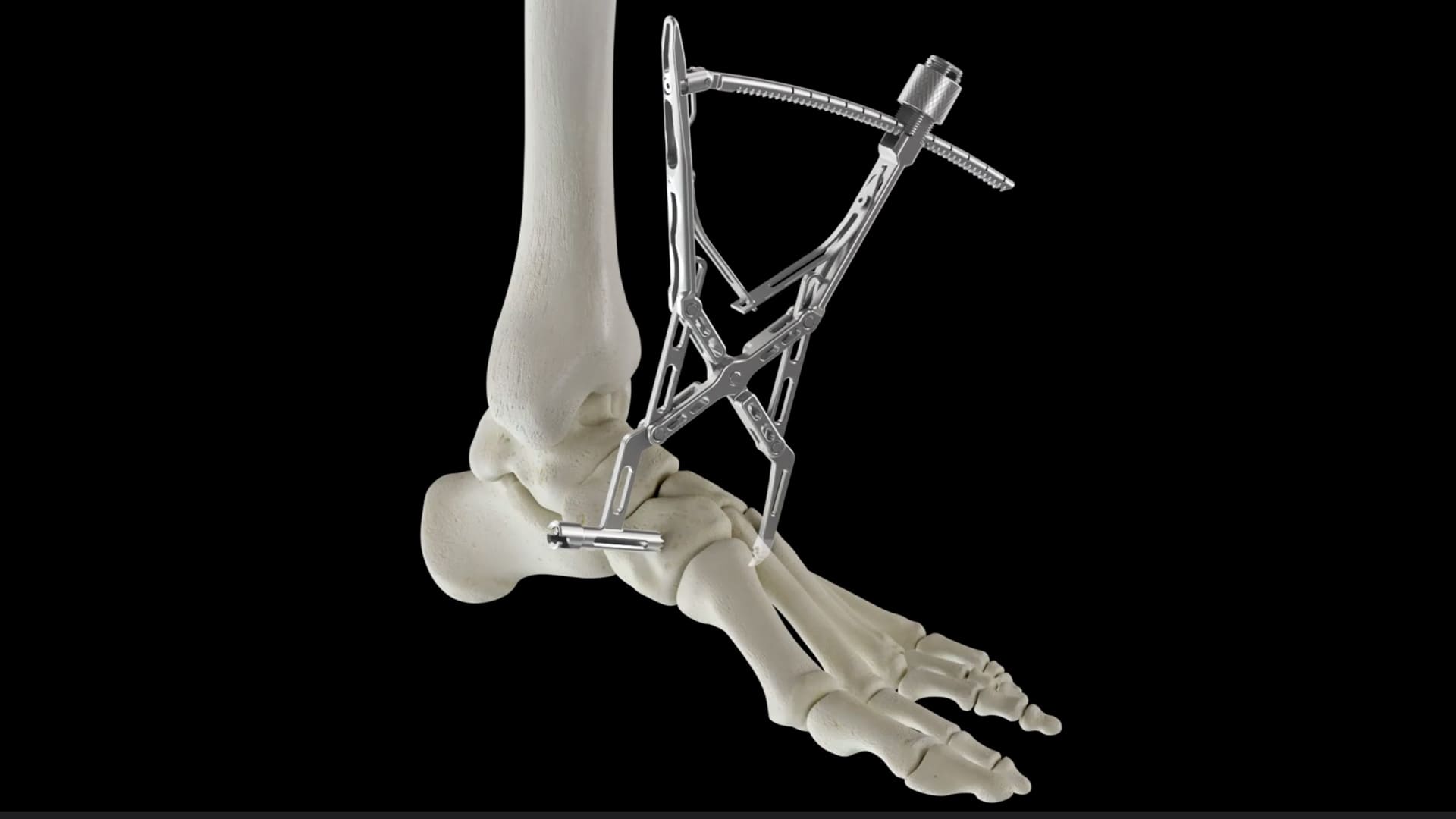 Lisfranc_Screw_Animation_Thumbnail-2-min