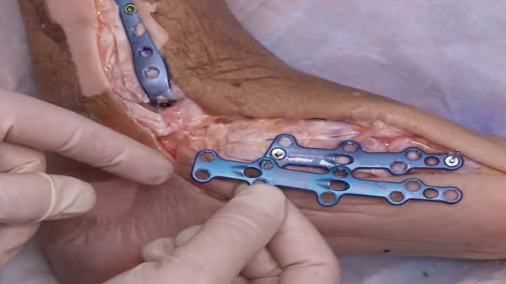Medial-Column-Fusion-Cadaveric-Demo