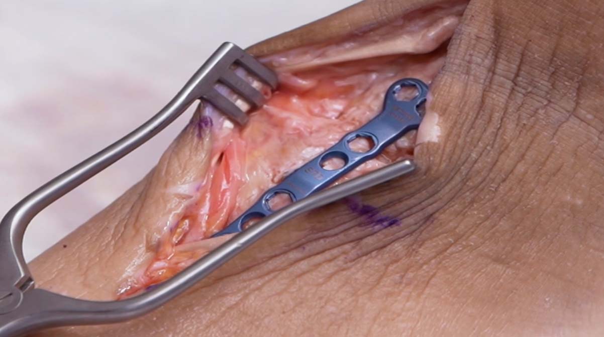 Middle-Column-Fusion-Cadaveric-Demo