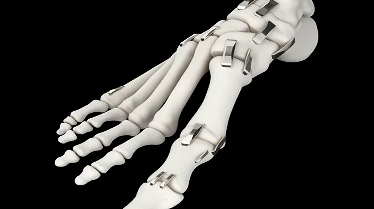 Nitinol-Staples-video