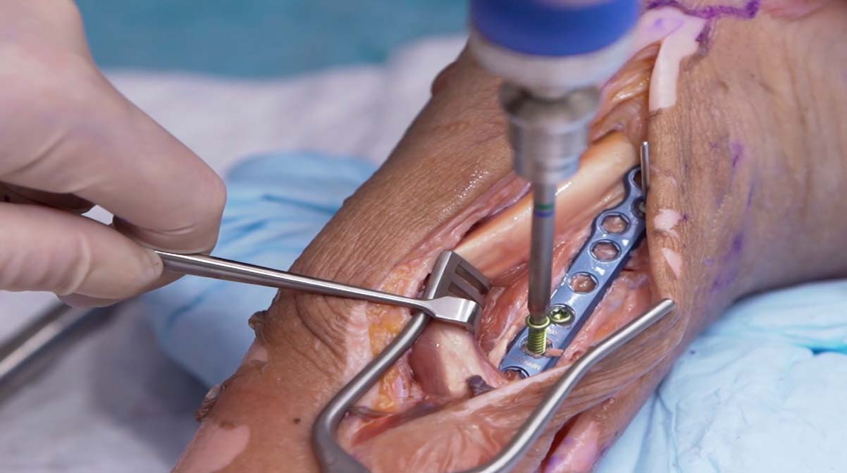 Posterior-Fibula-Cadaveric-Demo