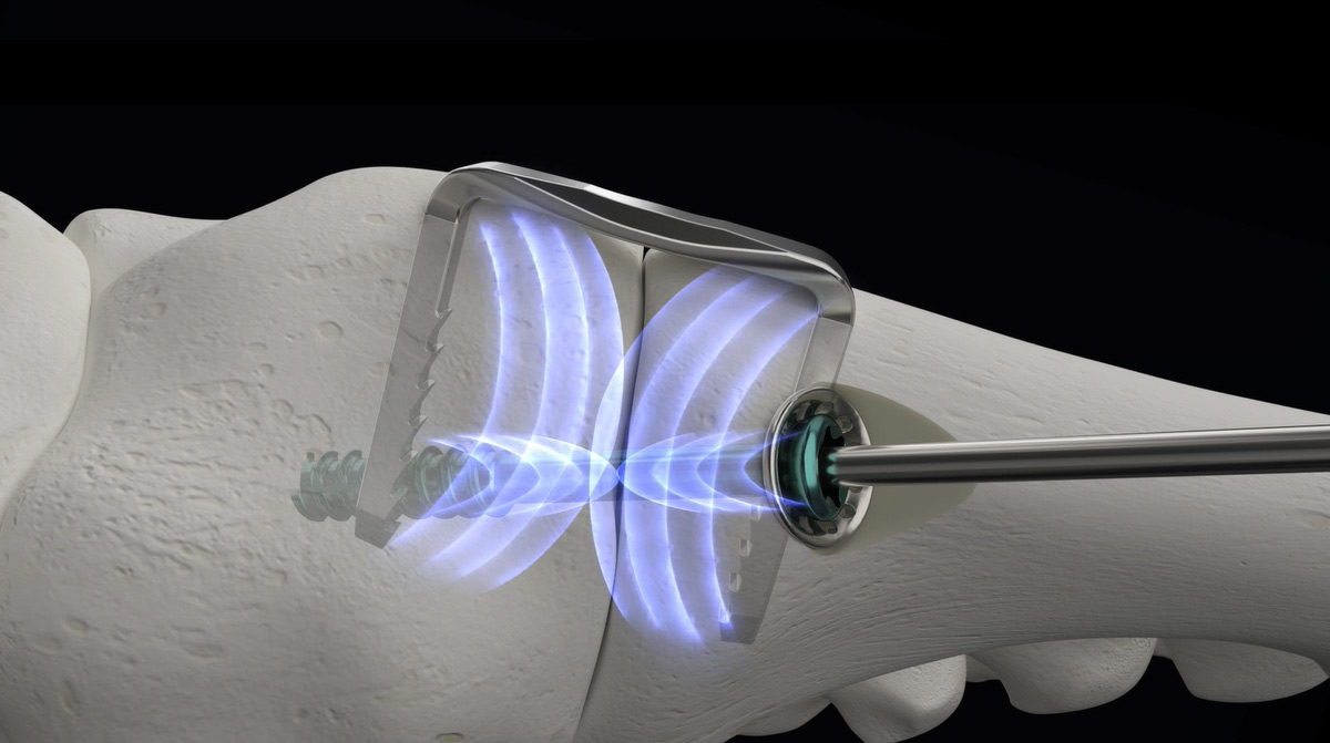 REFLEX-Nitinol-Dynamic-Disc-Overview