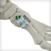 REFLEX® HYBRID Nitinol Implants