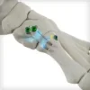 REFLEX® HYBRID Nitinol Implants - Image 2