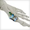 REFLEX® HYBRID Nitinol Implants - Image 3