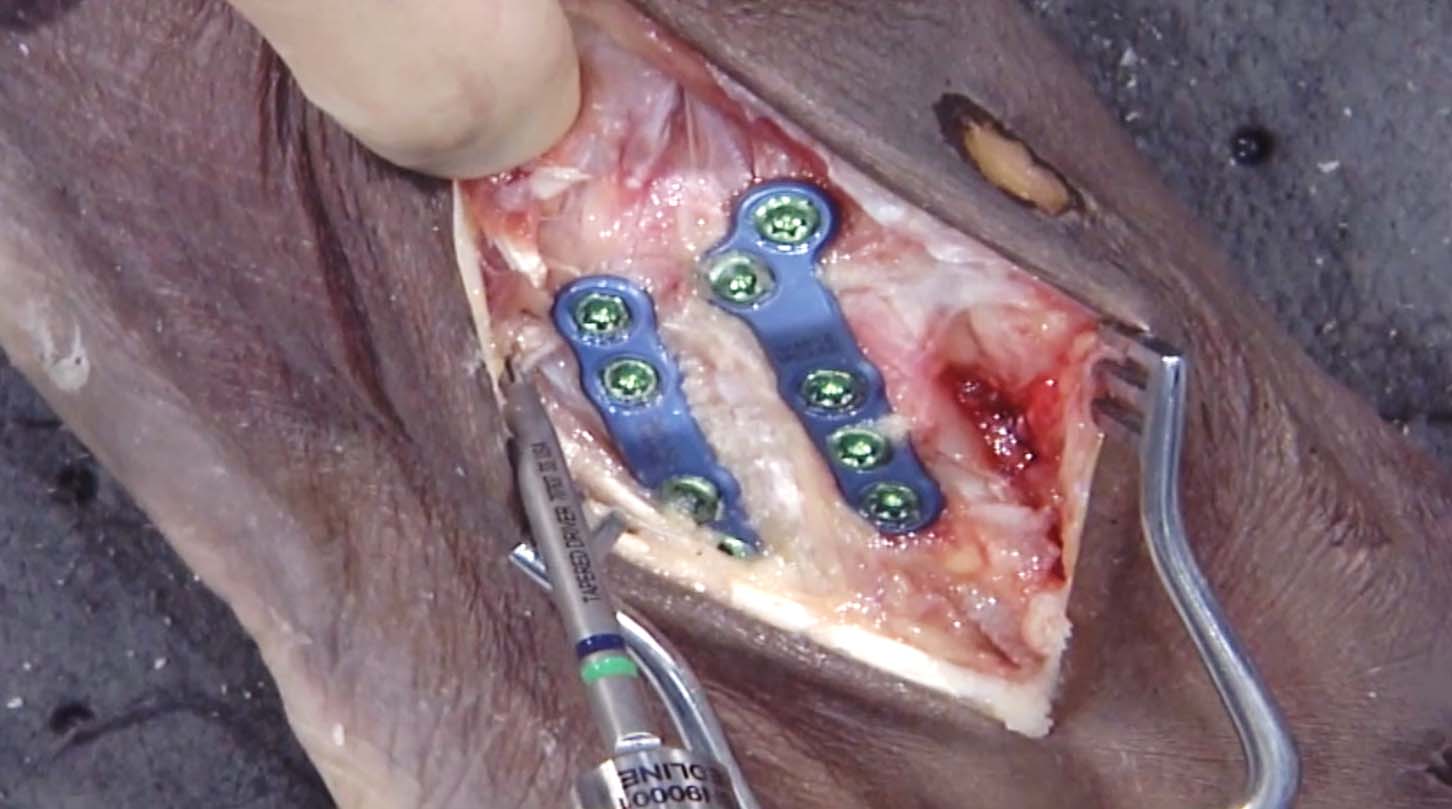 TMT-Fusion-Surgical-Technique-1